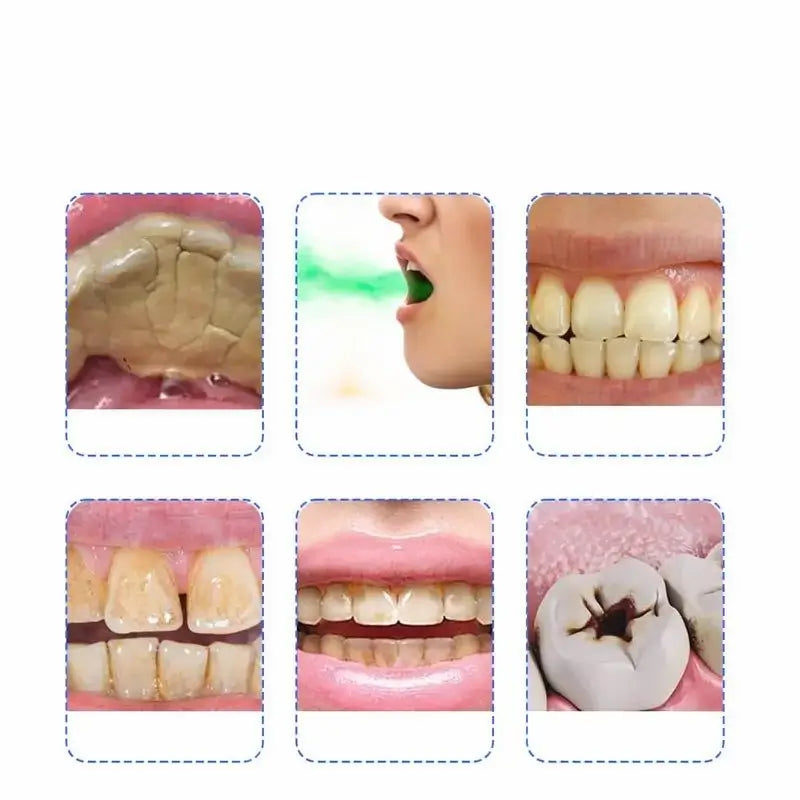 Limpiador Dental Eléctrico y Eliminador de Sarro Profesional - Quita Manchas y Placa en Casa para Prevenir Caries y Mal Aliento